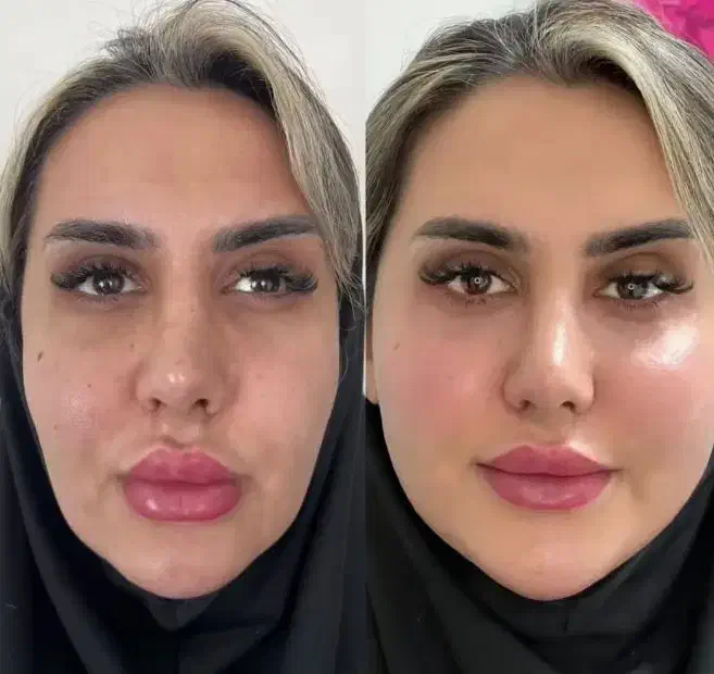 تخفیف کلینیک ژل بوتاکس نخ|خدمات آرایشگری و زیبایی|یاسوج, |دیوار