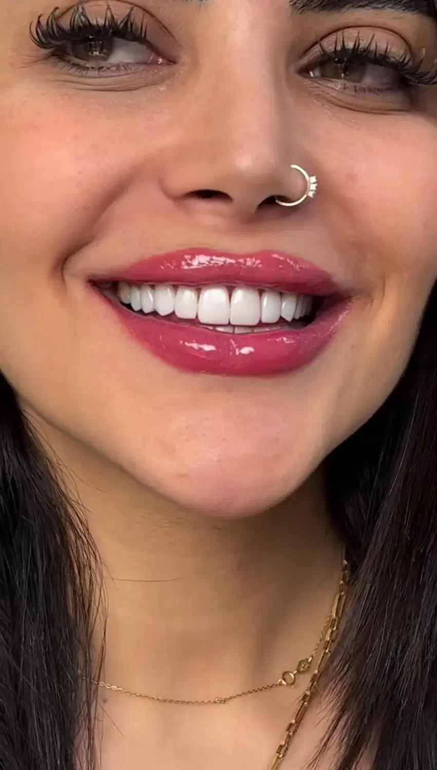 کامپوزیت دندان|خدمات آرایشگری و زیبایی|بناب, |دیوار