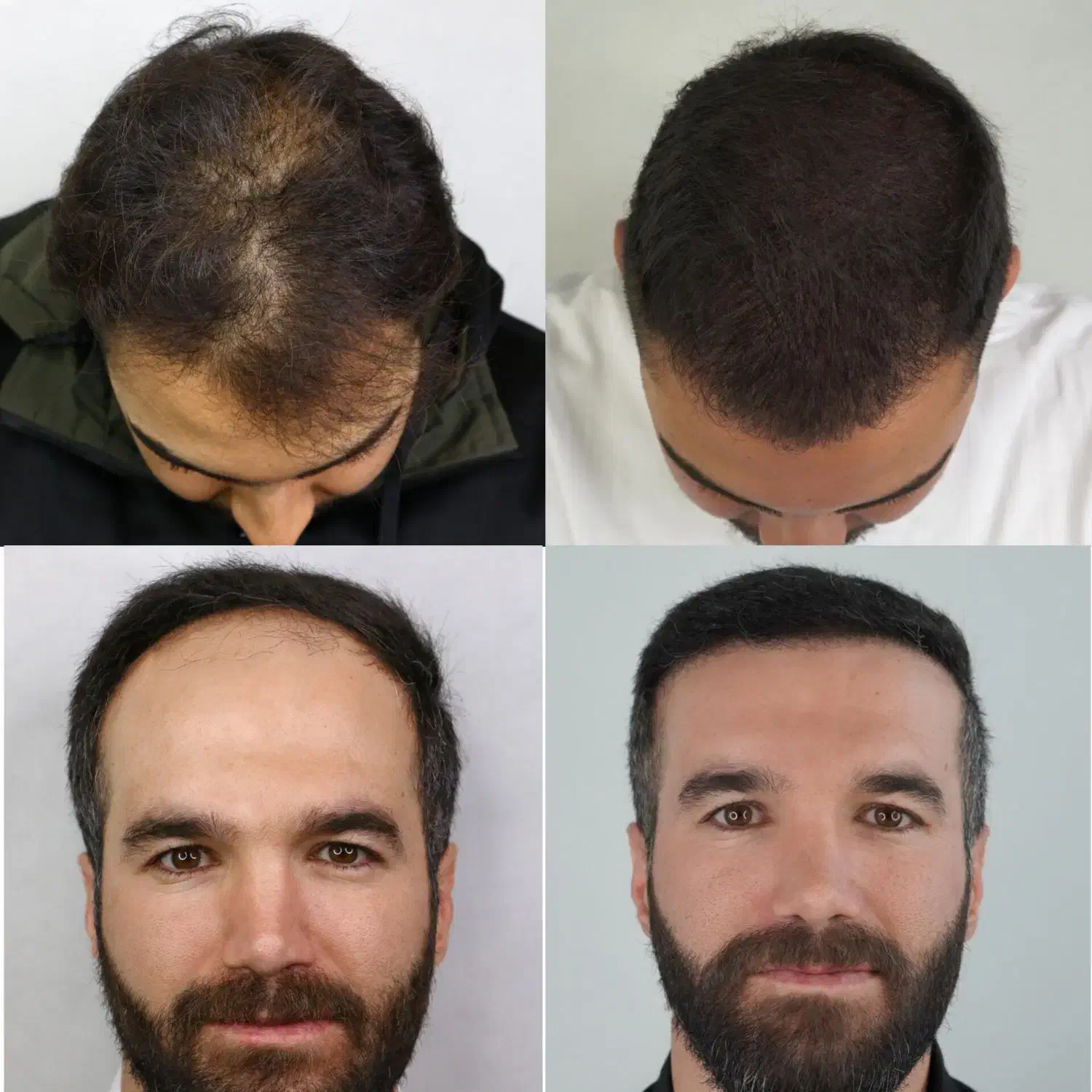 خدمات کاشت مو و ابرو به صورت اقساط|خدمات آرایشگری و زیبایی|شیراز, معالی‌آباد|دیوار