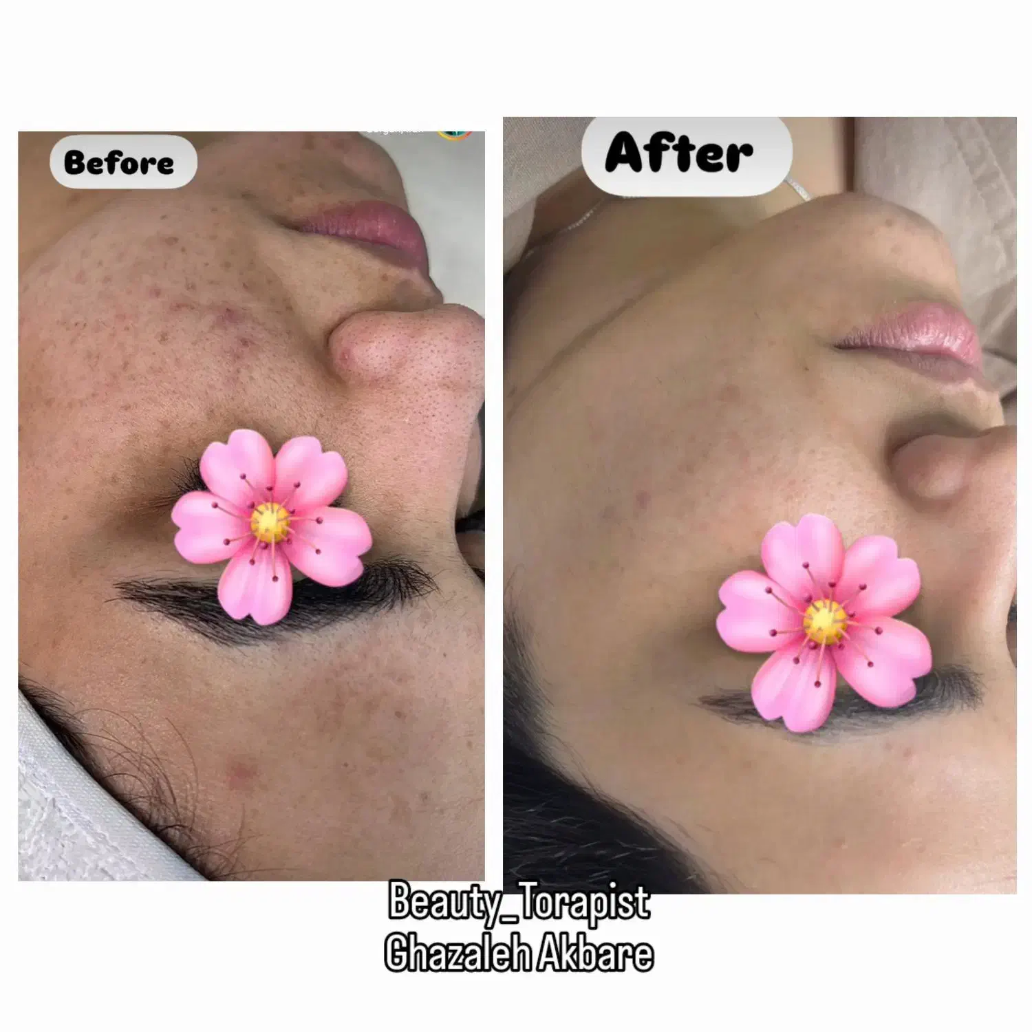 پاکسازی و جوانسازی پوست . هایفو صورت و غبغب|خدمات آرایشگری و زیبایی|مشهد, سجاد شهر|دیوار