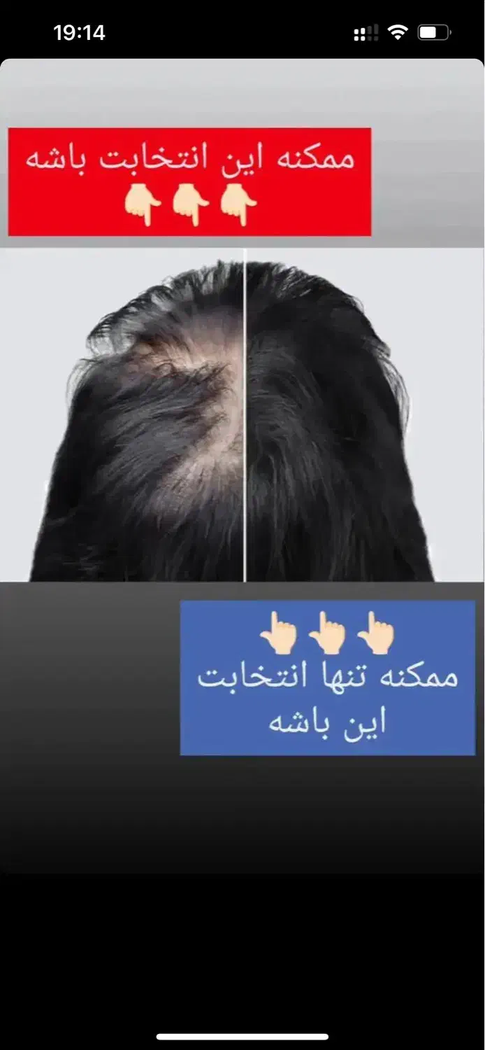 درمان ریشه ای ریزشمو،تقویت ورشدمجددموها|آرایشی، بهداشتی، درمانی|مینودشت, |دیوار