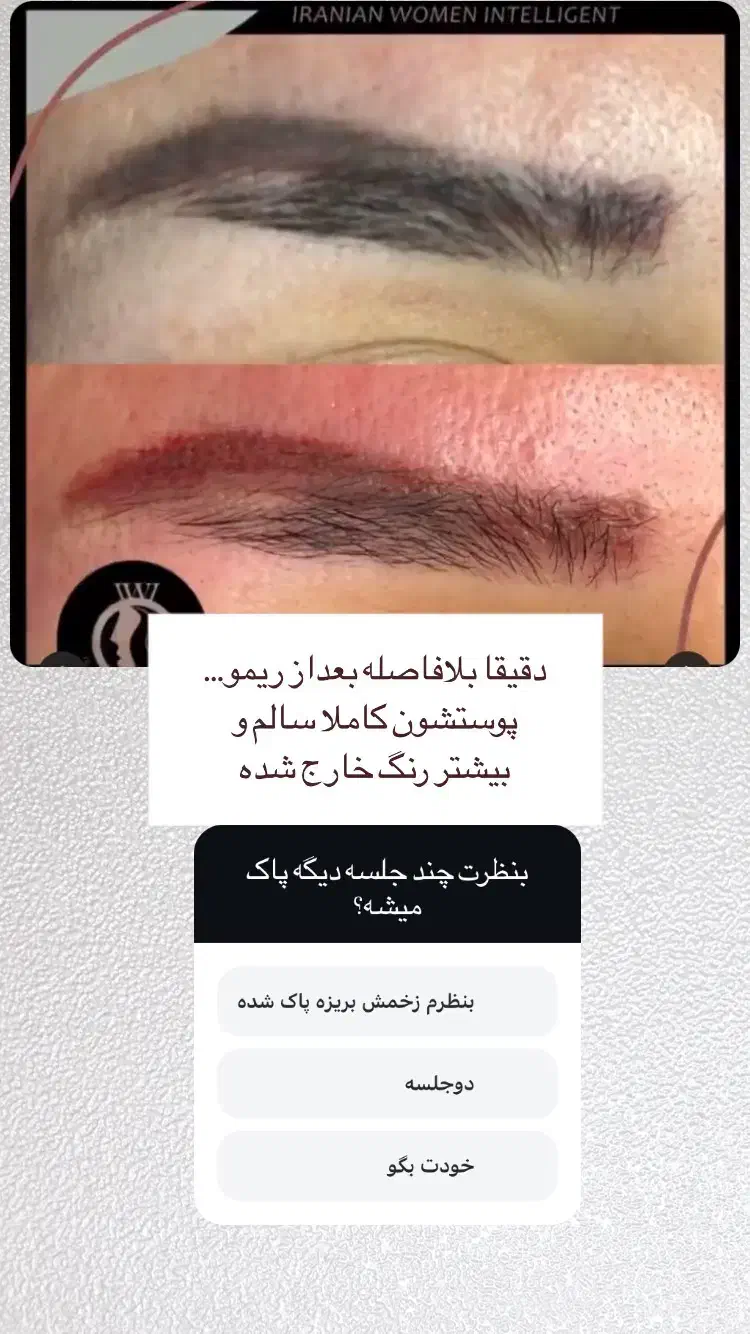 ریمو تتوی صورت(فقط بانوان)|خدمات آرایشگری و زیبایی|قم, کیوانفر|دیوار
