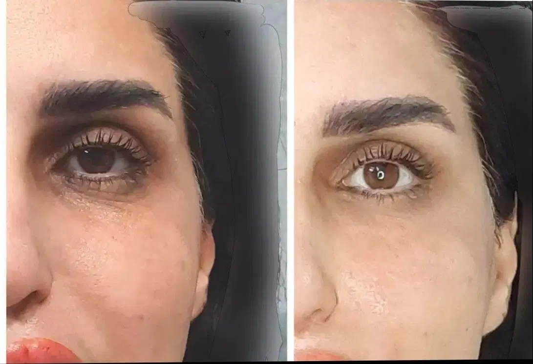 لیزر کل بدن ۴۴۰ مطب مسکن فیلر بوتاکس مزو|خدمات زیبایی و سلامت|کرمانشاه, |دیوار