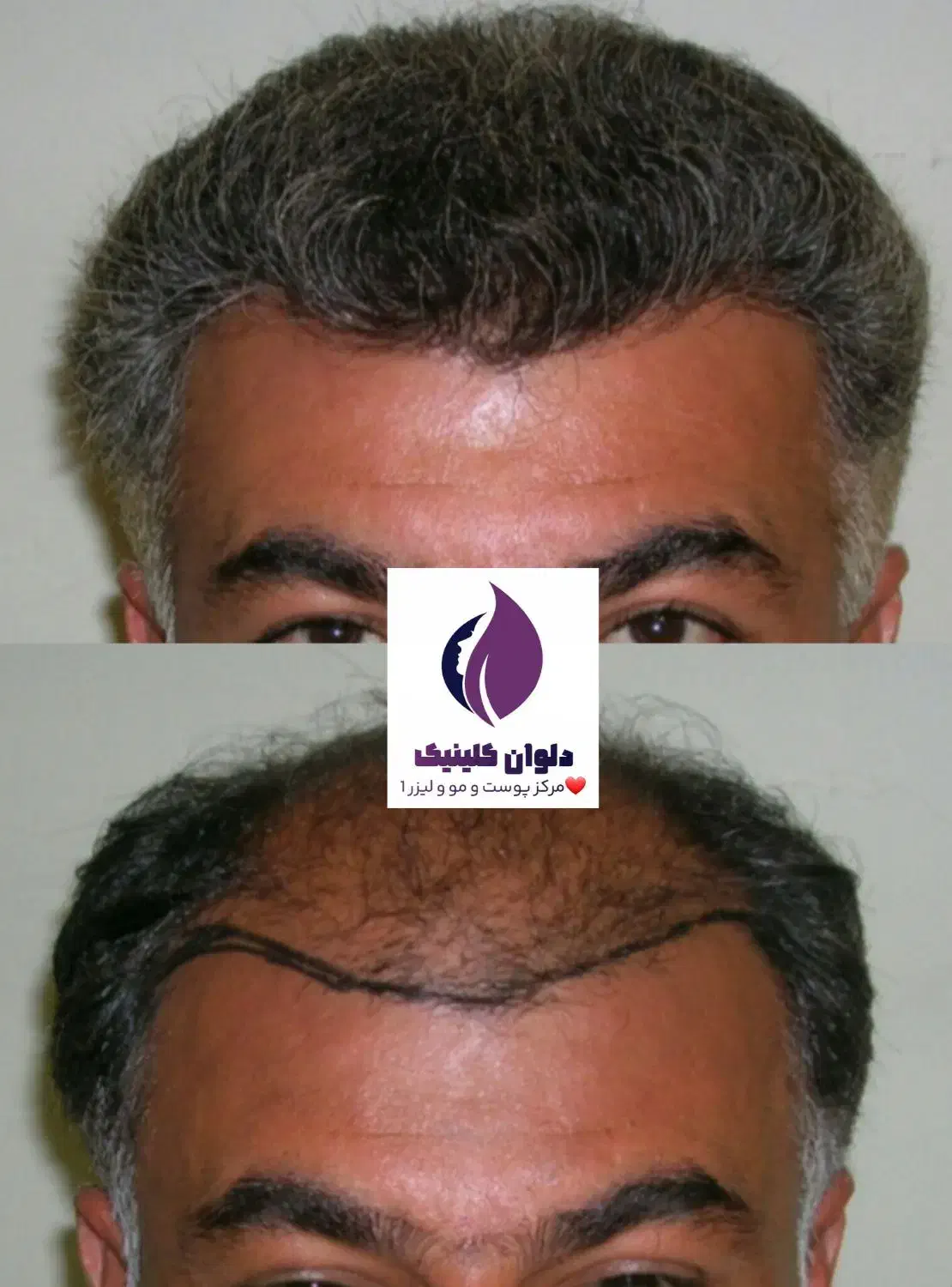 تخفیف پاییز تا یلدا کاشت مو و ابرو و مژه|خدمات آرایشگری و زیبایی|زاهدان, |دیوار