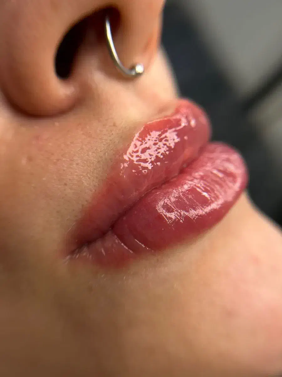 تزریق چربی، فیلر،بوتاکس/ساکشن چربی وتخلیه غبغب|خدمات آرایشگری و زیبایی|شهرضا, |دیوار