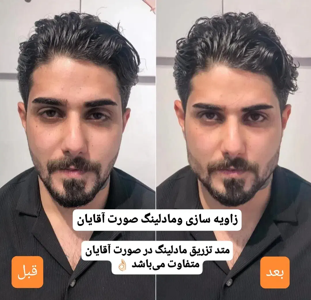 جشنواره/فیلر/بوتاکس/آنزیم/تخفیف دکترفیروزی|خدمات آرایشگری و زیبایی|شیراز, زرهی|دیوار