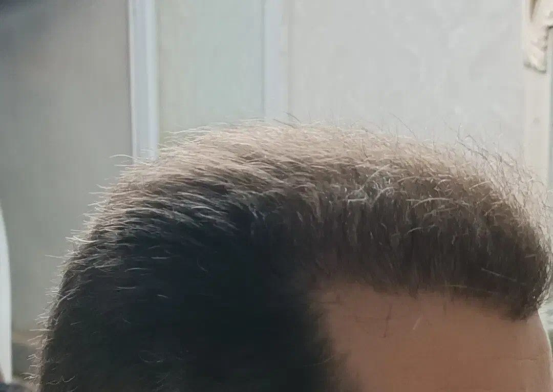 کاشت مو باضمانتنامه کتبی مادام العمر|خدمات آرایشگری و زیبایی|تبریز, |دیوار