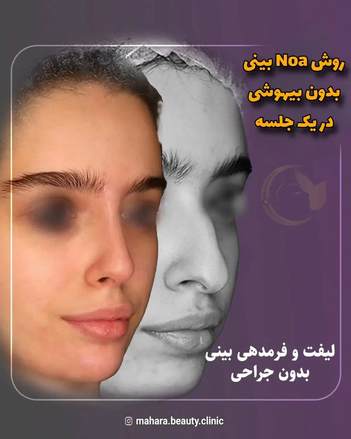 آف رینوپلاستی بینی بدون عمل جراحی NOA پزشک زیبایی|خدمات آرایشگری و زیبایی|مشهد, هفت تیر (آب و برق)|دیوار
