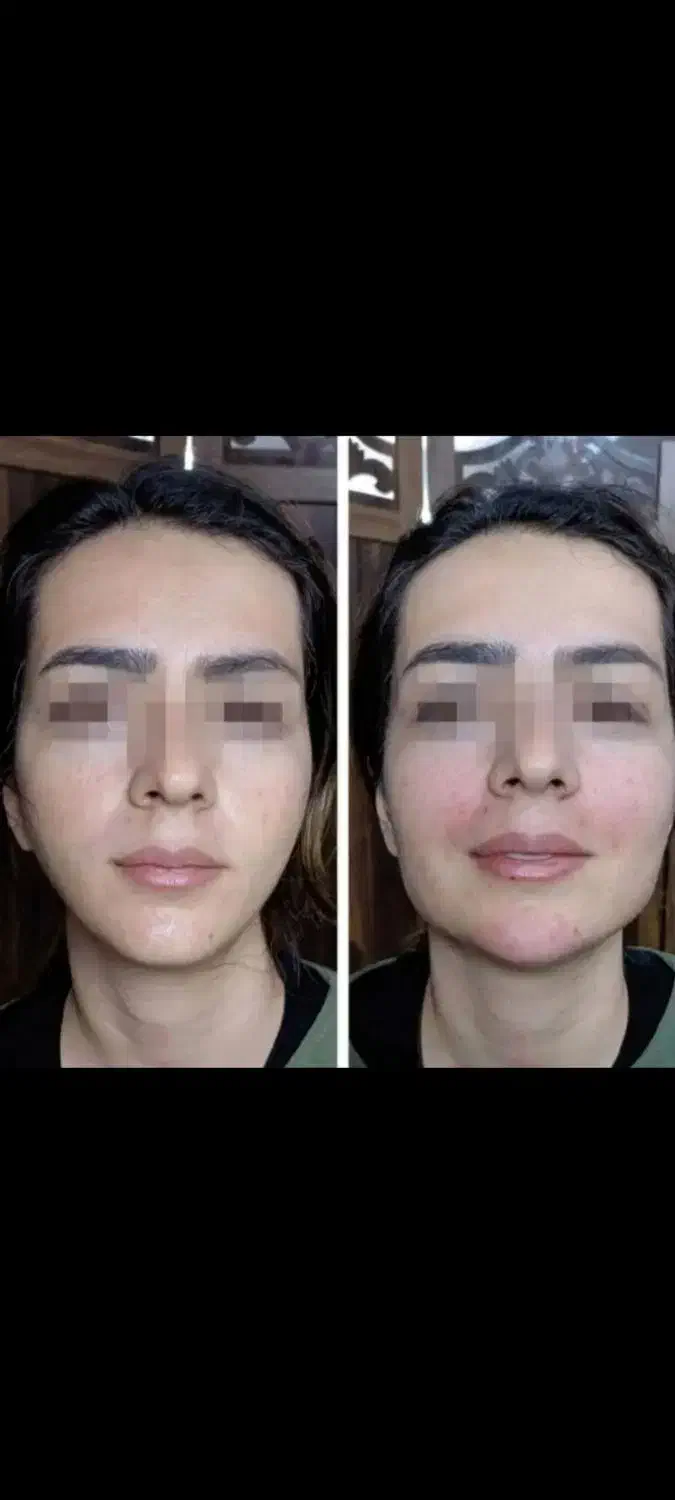 خدمات ژل وبوتاکس /کاشت مووابرو/باکمترین قیمت|خدمات آرایشگری و زیبایی|خرم‌آباد, |دیوار