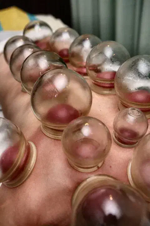 بادکش گرم/پنس بادکش/لیوان بادکش/لیوان حجامت|آرایشی، بهداشتی، درمانی|قم, دانش|دیوار