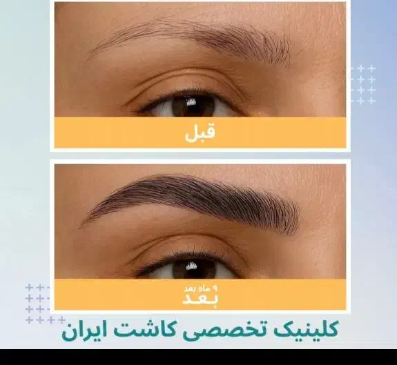 کاشت ابرو با قیمت استثنایی به مدت محدود|خدمات آرایشگری و زیبایی|تهران, دروس|دیوار