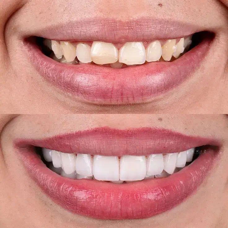 لبخندی رویایی با متریال برند های برتر کامپوزیت|خدمات آرایشگری و زیبایی|یاسوج, |دیوار