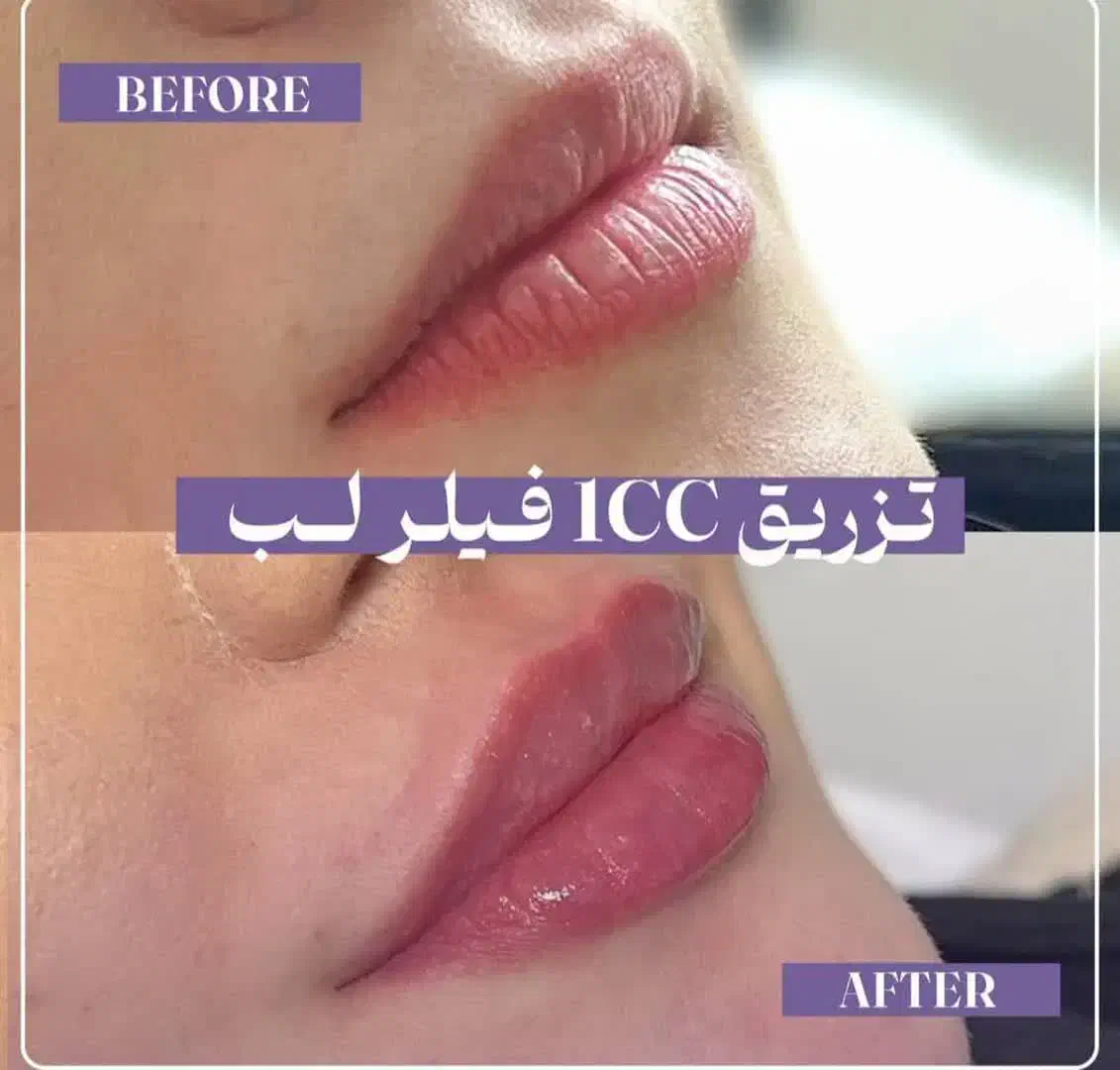 لیفت جراحی بینی بلفارو ژل لب بوتاکس مزو فشیال|خدمات آرایشگری و زیبایی|شاهین‌شهر, طالقانی|دیوار