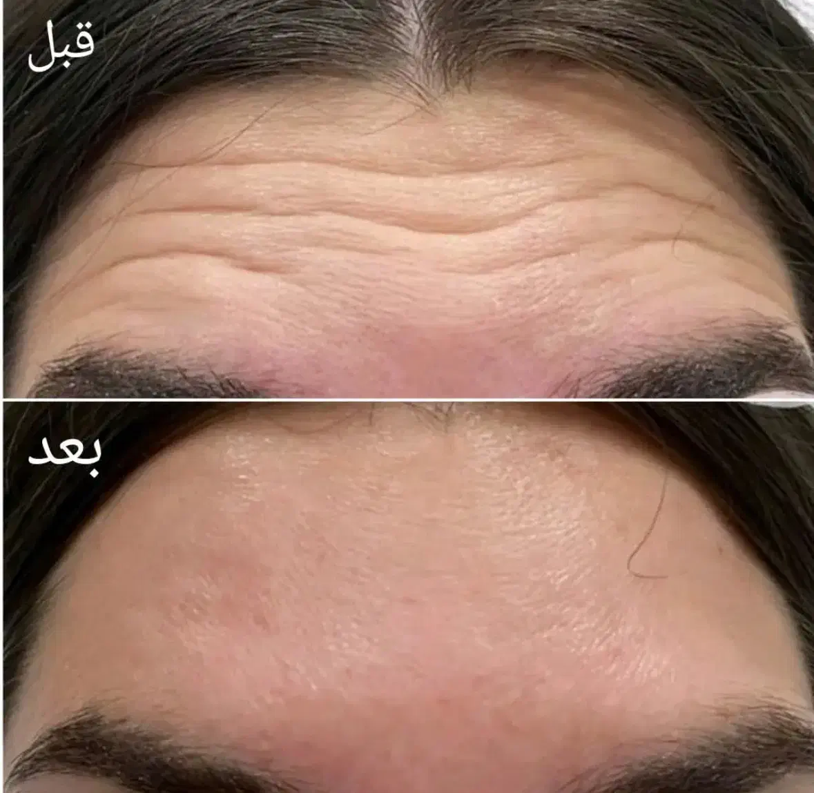 تزریق بوتاکس توسط پزشک ۷۸۰ت|خدمات آرایشگری و زیبایی|شیراز, کوی وحدت|دیوار