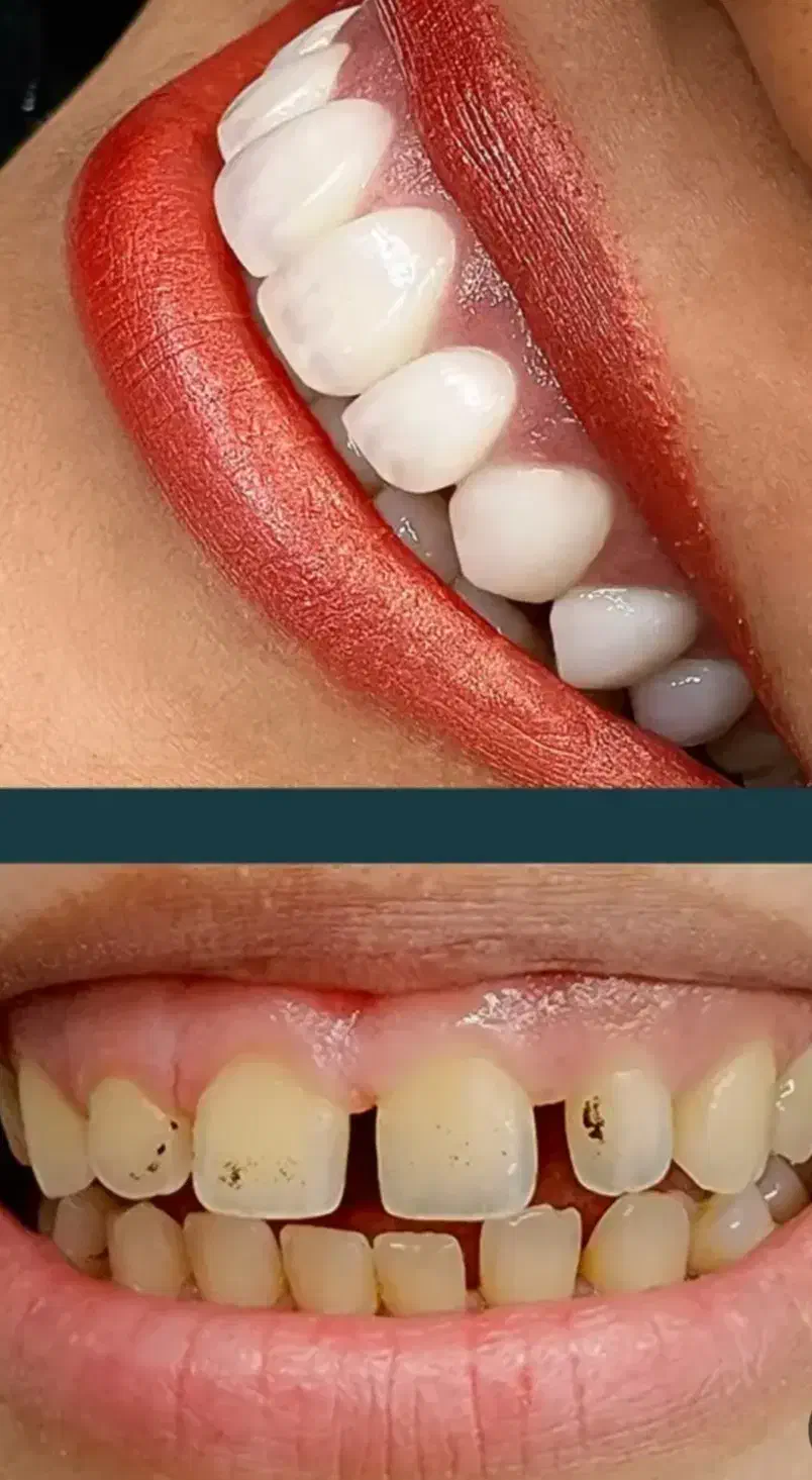 جشنواره کامپوزیت دندان فقط واحدی 700|خدمات آرایشگری و زیبایی|فولادشهر, B4|دیوار