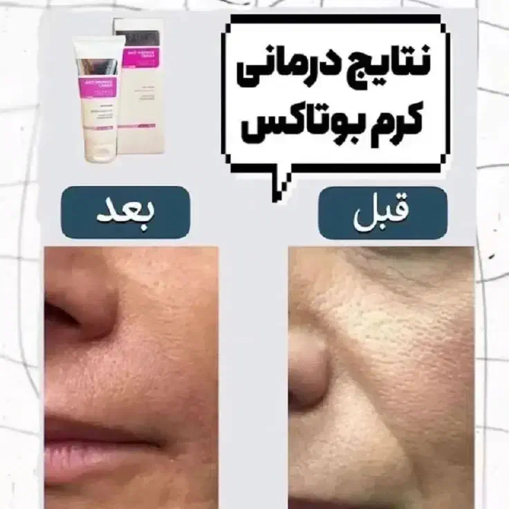 بوتاکس پوست صورت|آرایشی، بهداشتی، درمانی|آزادشهر, |دیوار