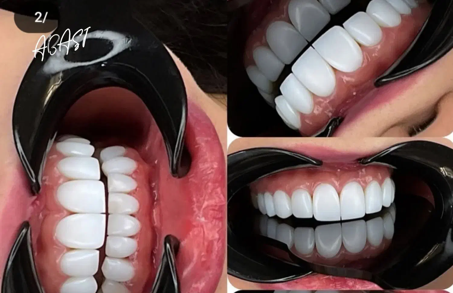 ایمپلنت و کامپوزیت دندان فقط از 10|خدمات آرایشگری و زیبایی|نورآباد, |دیوار