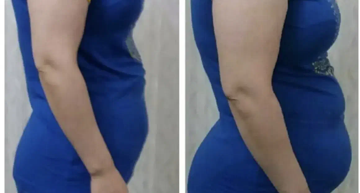 لاغری موضعی بادستگاه،مزوتراپی چربی سوز،رژیم درمانی|خدمات آرایشگری و زیبایی|زنجان, |دیوار