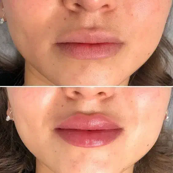 تخفیف ویژه روی کلیه کارهای زیبایی فیلر و بوتاکس|خدمات آرایشگری و زیبایی|شیراز, تاچارا|دیوار