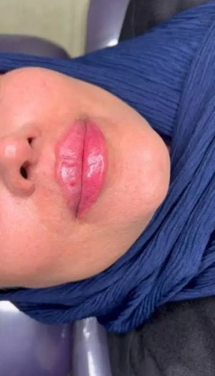 ژل ، بوتاکس ، چربی ، فیلر|خدمات آرایشگری و زیبایی|کرمانشاه, |دیوار