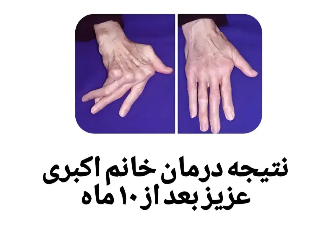 رماتیسم،نقرس ،ارتریت روماتوئید|آرایشی، بهداشتی، درمانی|بندر انزلی, گیلار|دیوار