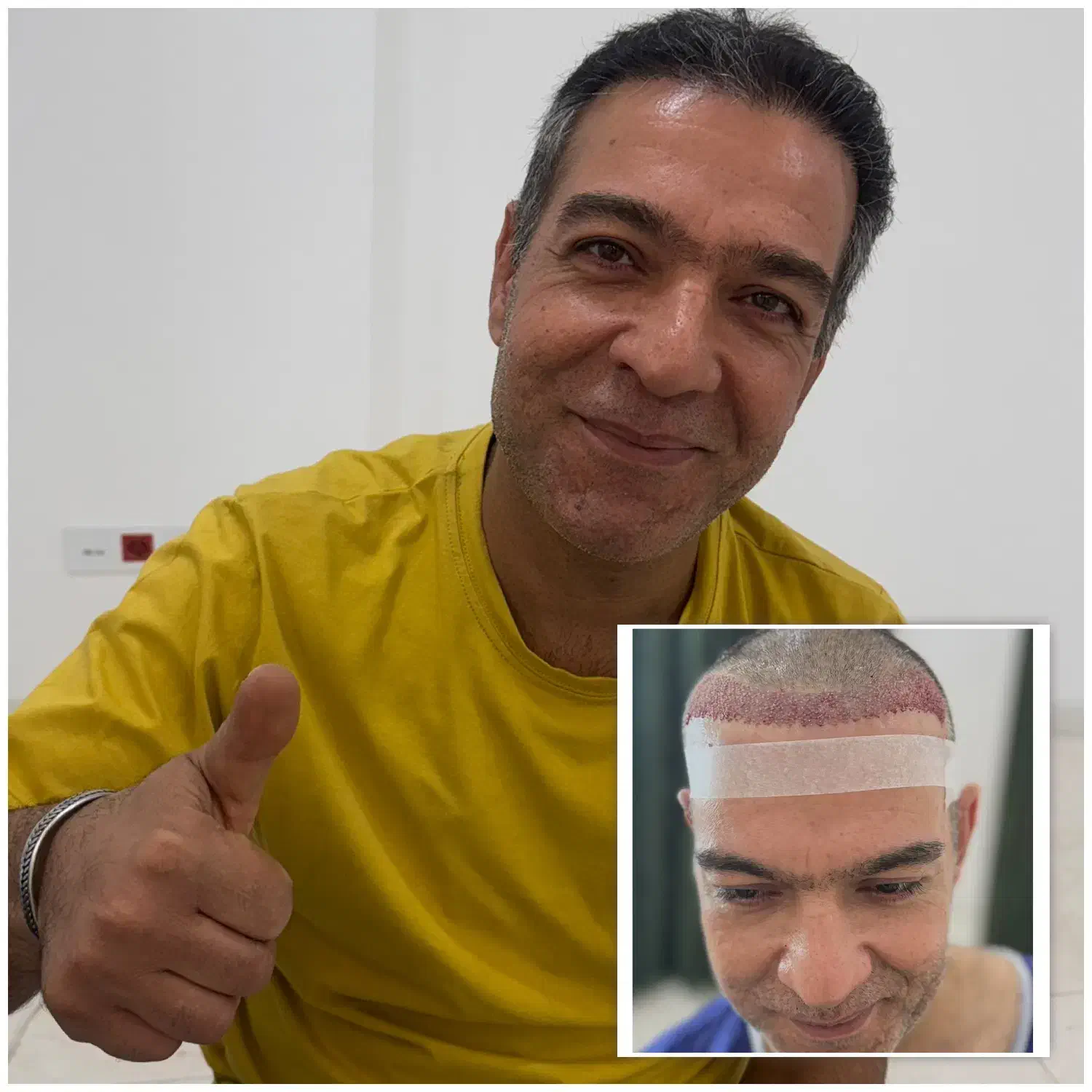 کاشت مو یا معجزه.خط رویش طبیعی تراکم بالا تضمینی|خدمات آرایشگری و زیبایی|یزد, |دیوار