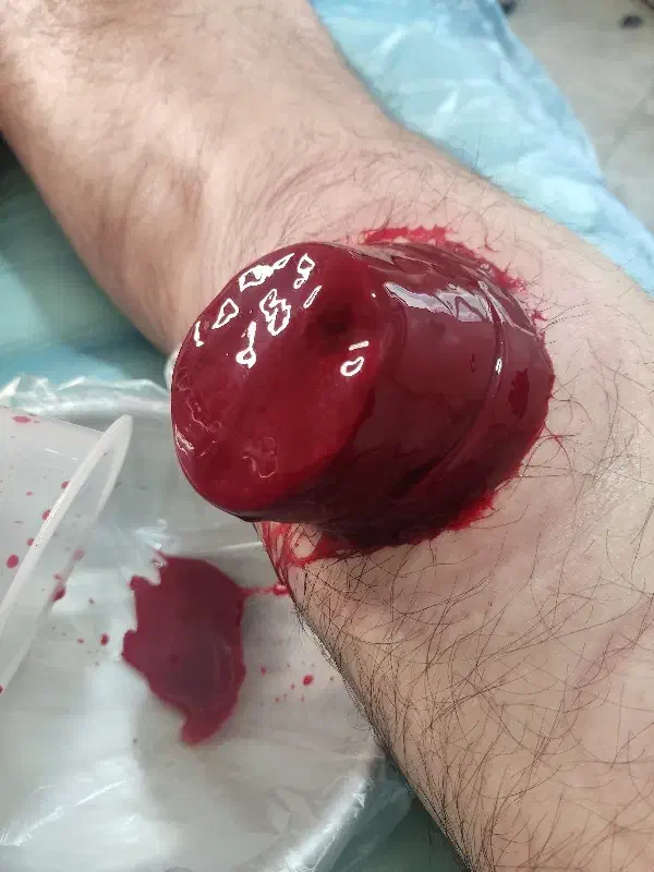 حجامت، زالودرمانی،بادکش درمانی در پرند|خدمات آرایشگری و زیبایی|پرند, فاز ۵|دیوار