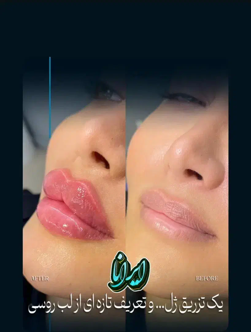 تزریق ژل و بوتاکس تضمینی (کلنیک ایرانا)|خدمات آرایشگری و زیبایی|یاسوج, |دیوار