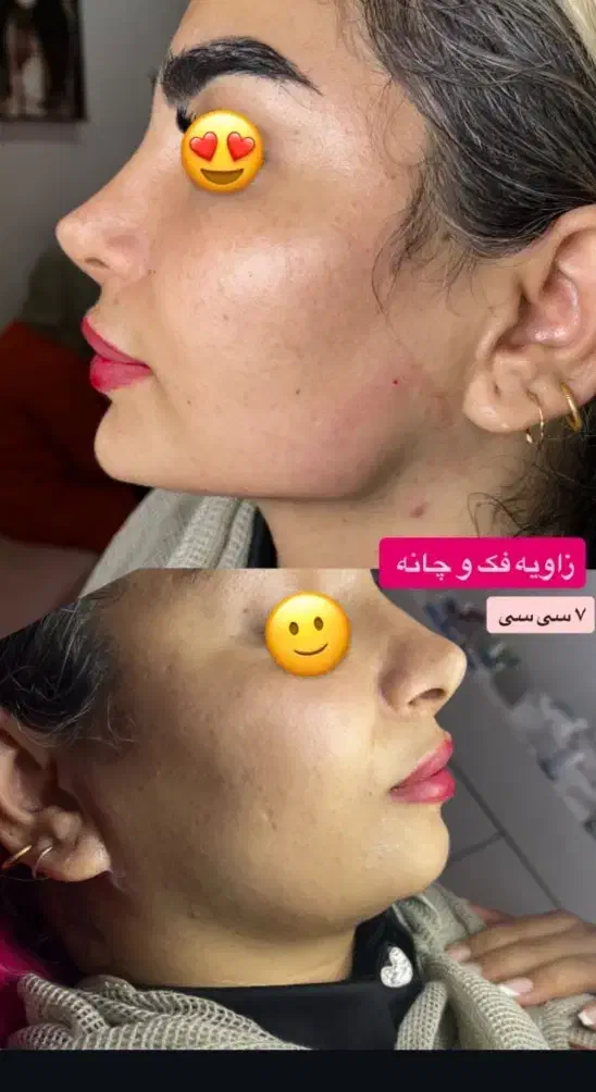 جشنواره فیلر و بوتاکس با بهترین متریال|خدمات آرایشگری و زیبایی|یزد, |دیوار