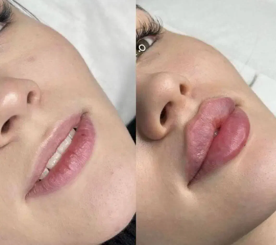 ژل لب گونه چونه زاویه خدمات پرسینگ|خدمات آرایشگری و زیبایی|صدرا-فارس, فاز ۱|دیوار