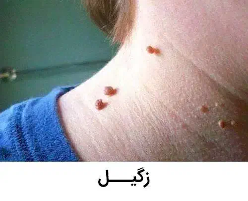 برداشتن زگیل و میخچه در یک جلسه|خدمات آرایشگری و زیبایی|قم, نیروگاه|دیوار
