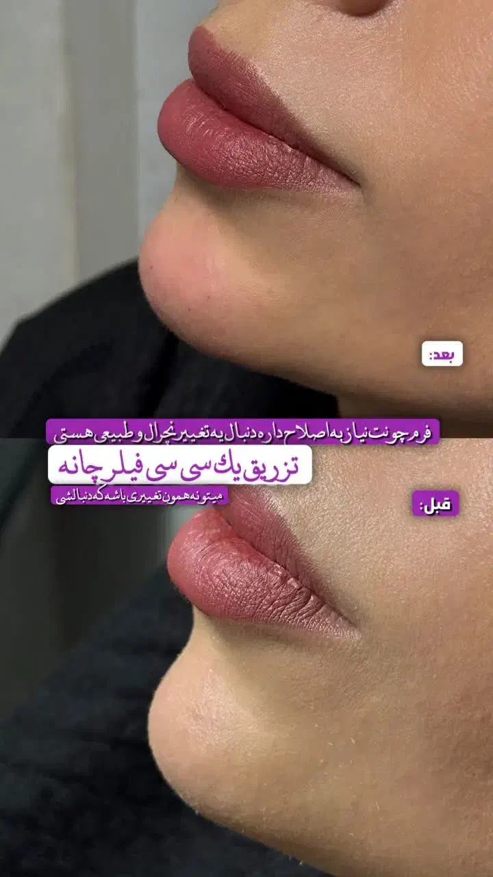 لیزر موهای زائد با دستگاه الکس و تیتانیوم|خدمات آرایشگری و زیبایی|قم, صفائیه|دیوار