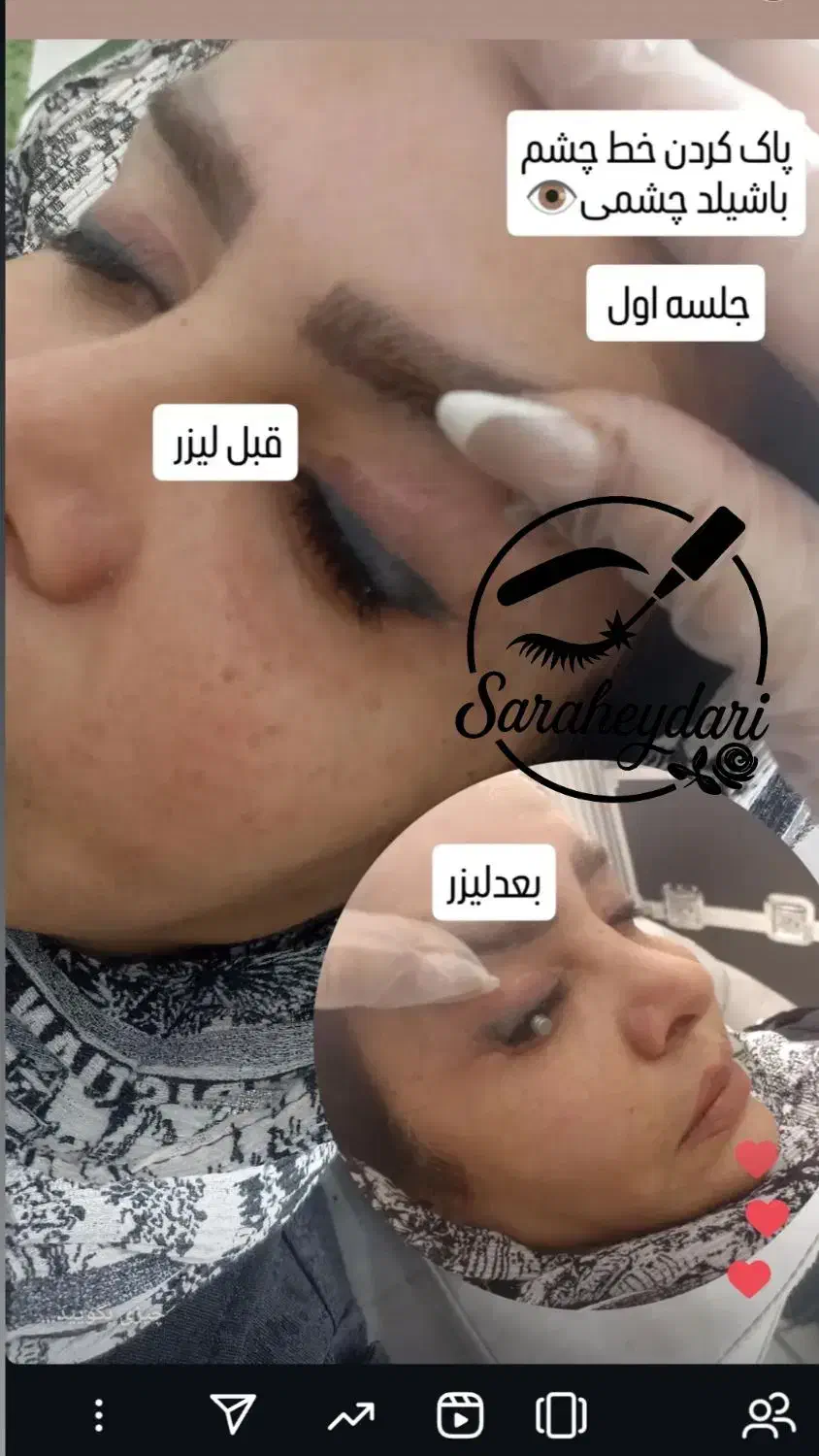پاککردن تاتو صورت و بدن.تخفیف تا پایان هفته|خدمات آرایشگری و زیبایی|کرمانشاه, |دیوار