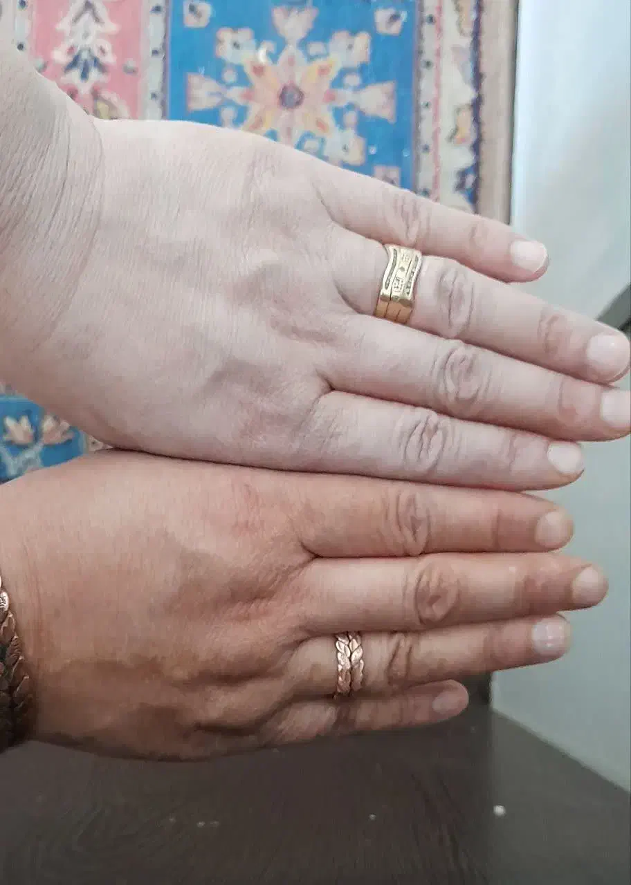 از تیرگی های صورت و بدنت خلاص شو|آرایشی، بهداشتی، درمانی|پشتکوه (سیستان و بلوچستان), |دیوار