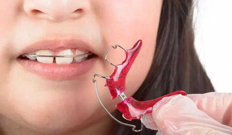 ارتودنسی به نرخ دولتی برای کودکان ۸ تا ۱۲ سال|خدمات آرایشگری و زیبایی|تهران, دروس|دیوار