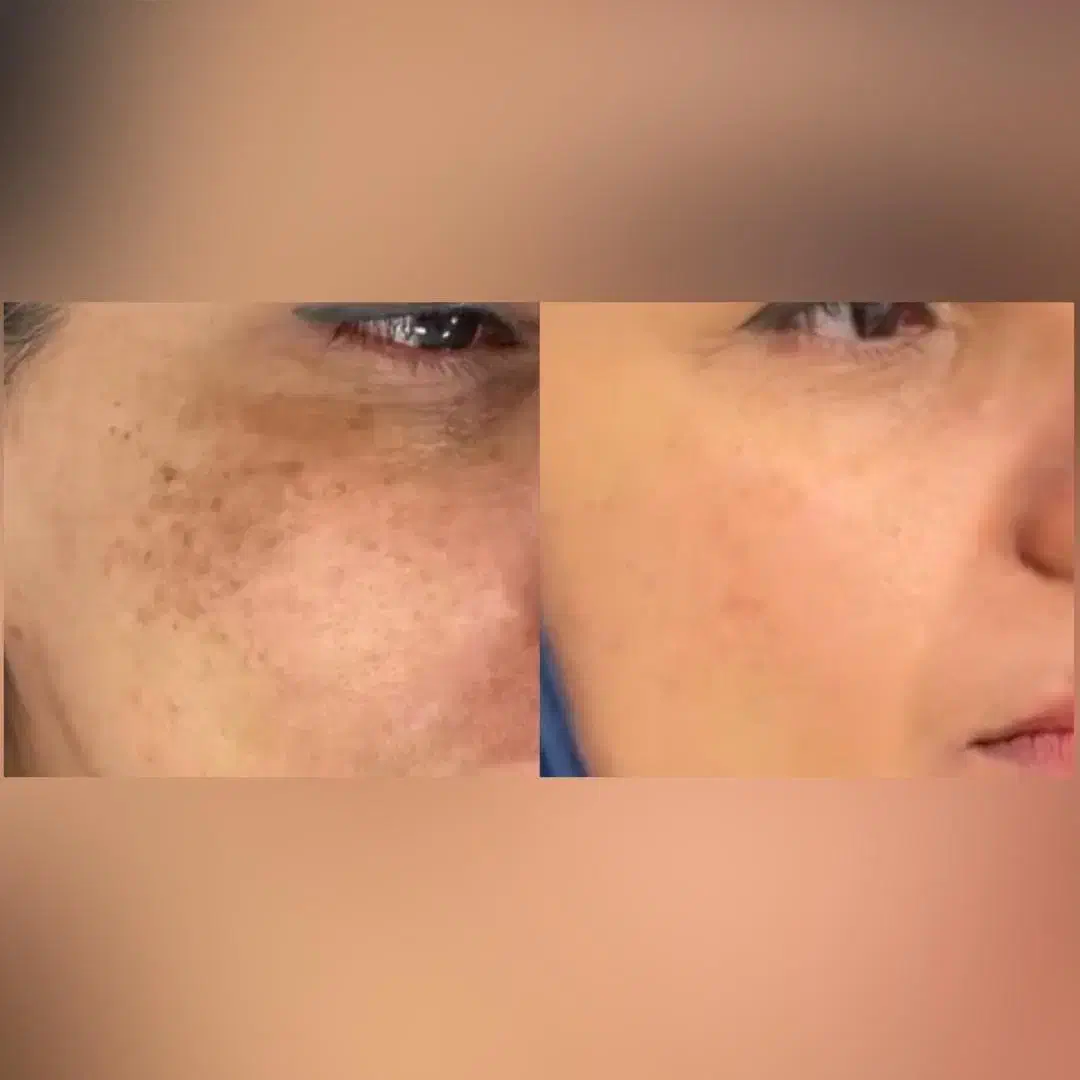 مزوتراپی &  PRP|خدمات آرایشگری و زیبایی|بندر انزلی, شاکوچه|دیوار
