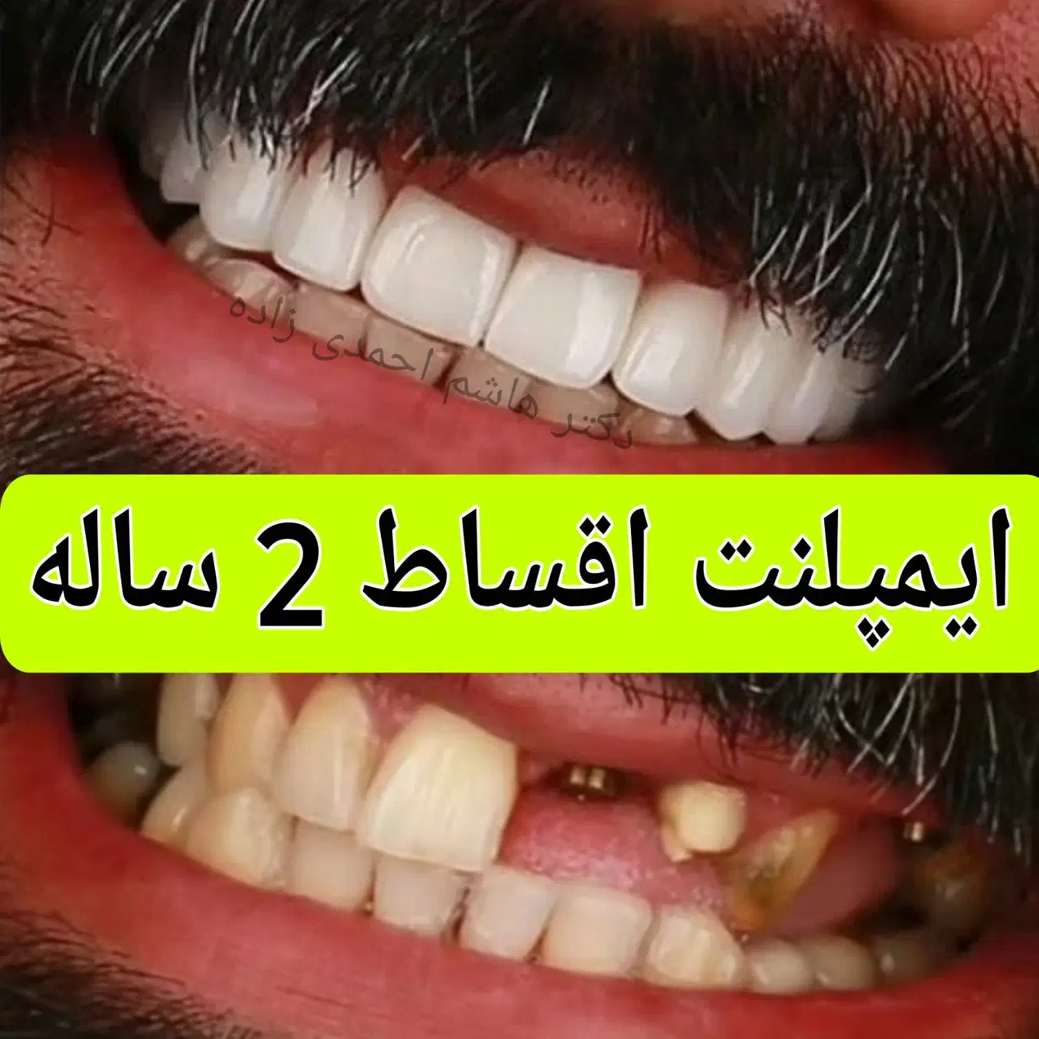 ایمپلنت دیجیتال دندانپزشکی کاشت اوردنچر روکش اقساط|خدمات آرایشگری و زیبایی|تهران, فرمانیه|دیوار