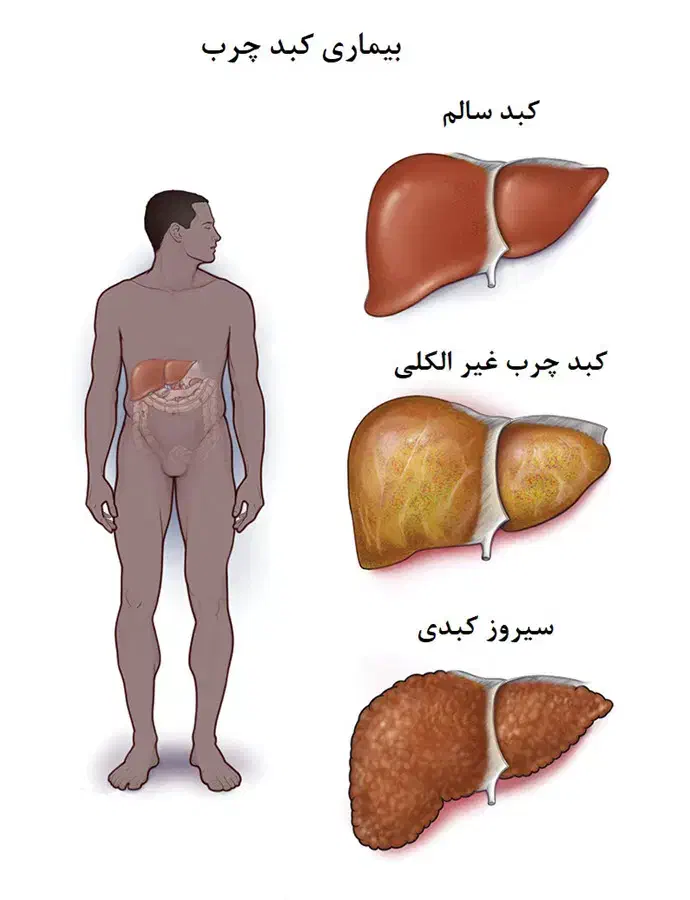 پاکسازی کبد چرب|آرایشی، بهداشتی، درمانی|گنبد کاووس, |دیوار