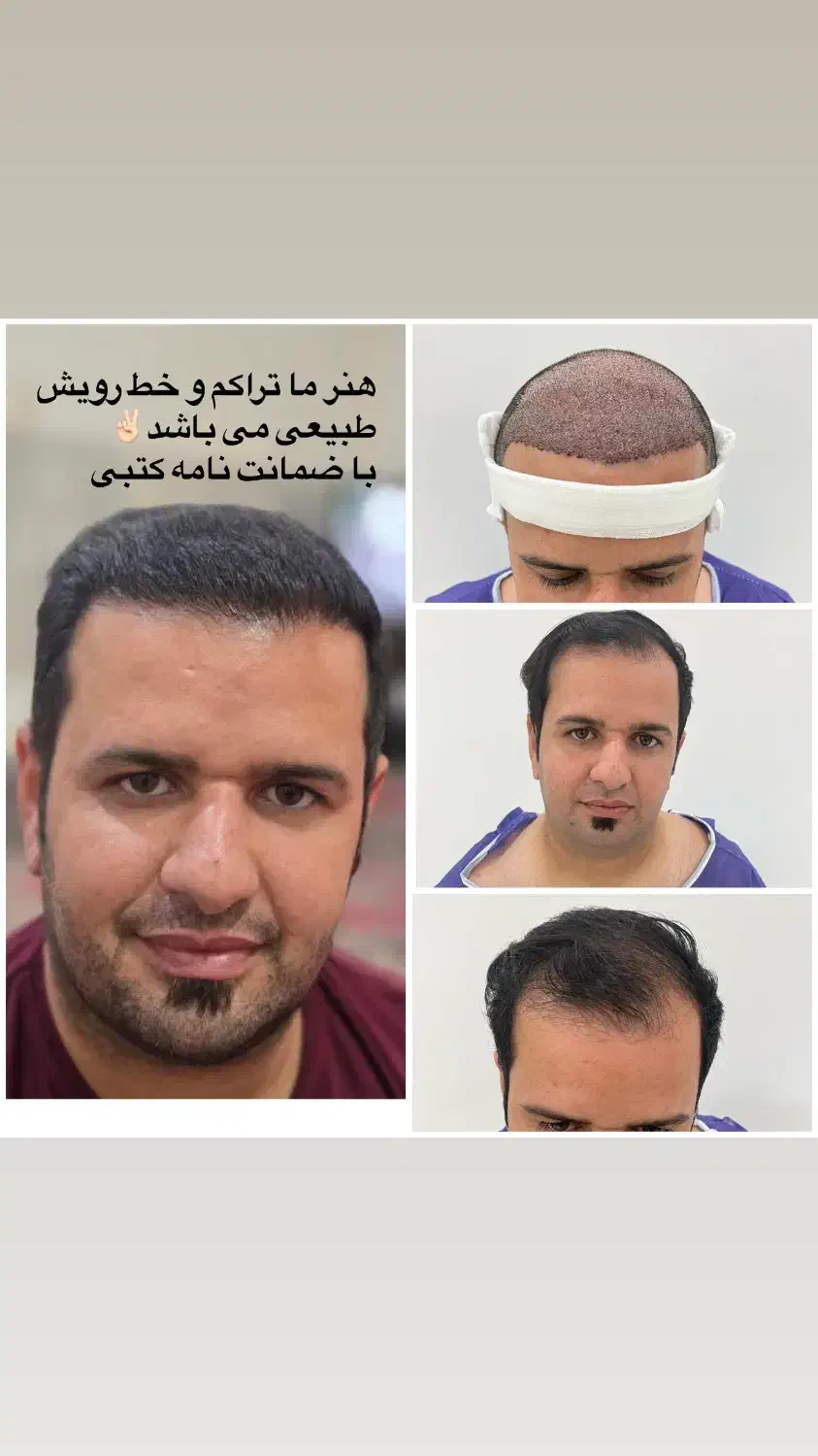 کاشت مو تخصصی vip کار شیرازی،۱۰۰ درصد تضمینی|خدمات آرایشگری و زیبایی|یزد, |دیوار