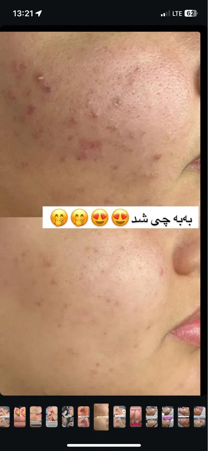 فیشال تخصصی خانم ها واقایان تحت نظر پزشک|خدمات آرایشگری و زیبایی|زاهدان, |دیوار