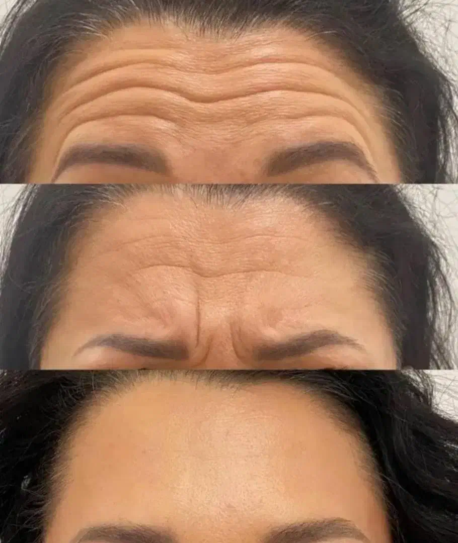 تزریق ژل وبوتاکس(سی سی ۵۰۰)ارایش دائم صورت،پیرسینگ|خدمات آرایشگری و زیبایی|آزادشهر, |دیوار