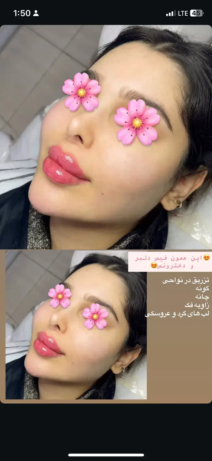 تزریق ژل وجوانسازی تخصصی ومزو ژل،بوتاکس|خدمات آرایشگری و زیبایی|شاهین‌شهر, فردوسی|دیوار