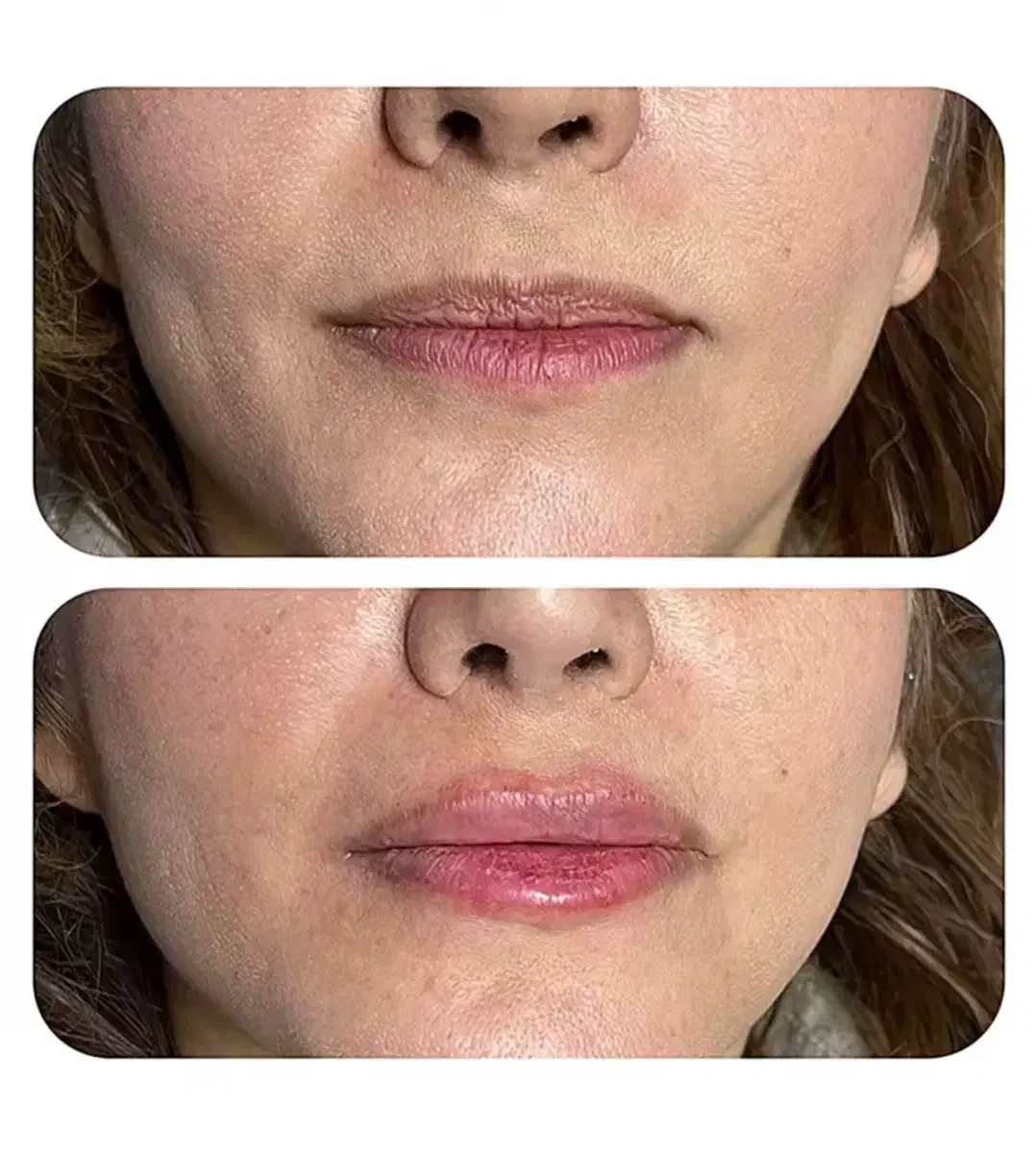 تزریق ژل و بوتاکس|خدمات آرایشگری و زیبایی|امیدیه, |دیوار