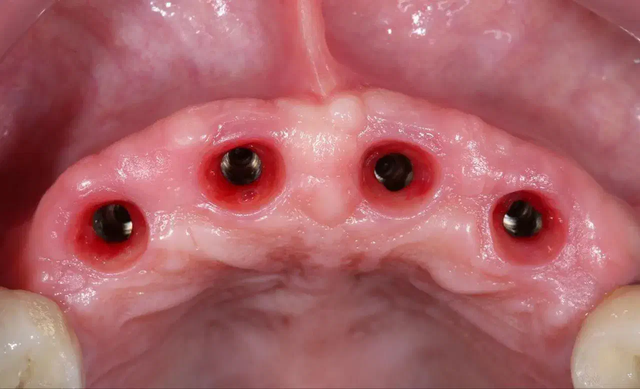 دندانپزشکی اوردنچر دوفک فقط ۱۰۰ تومن در تبریز|خدمات آرایشگری و زیبایی|اهر, |دیوار