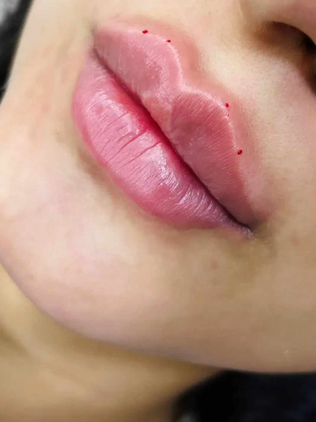 تزریق فیلر و بوتاکس و نخ توسط دستیار پزشک|خدمات آرایشگری و زیبایی|خرمشهر, |دیوار