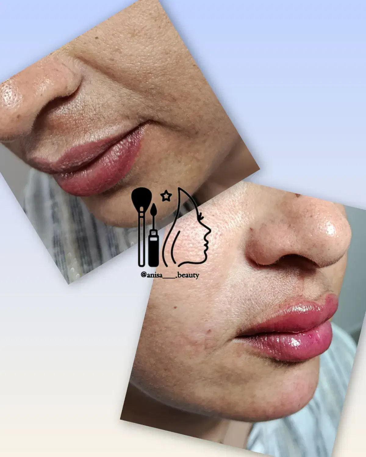 تزریق ژل و بوتاکس|خدمات آرایشگری و زیبایی|جهرم, |دیوار