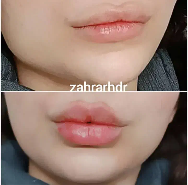 خدمات ژل فیلربوتاکس مزوژل درکلینیک با اف ویژه|خدمات آرایشگری و زیبایی|زاهدان, |دیوار