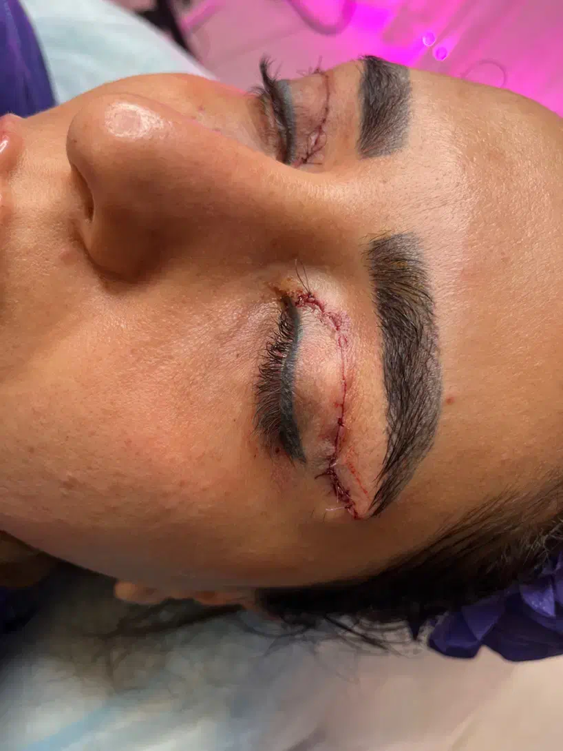 تخفیف ویژه جراحی پلک(بلفاروپلاستی)ژل لب یک میلیون|خدمات آرایشگری و زیبایی|مشهد, فردوسی|دیوار