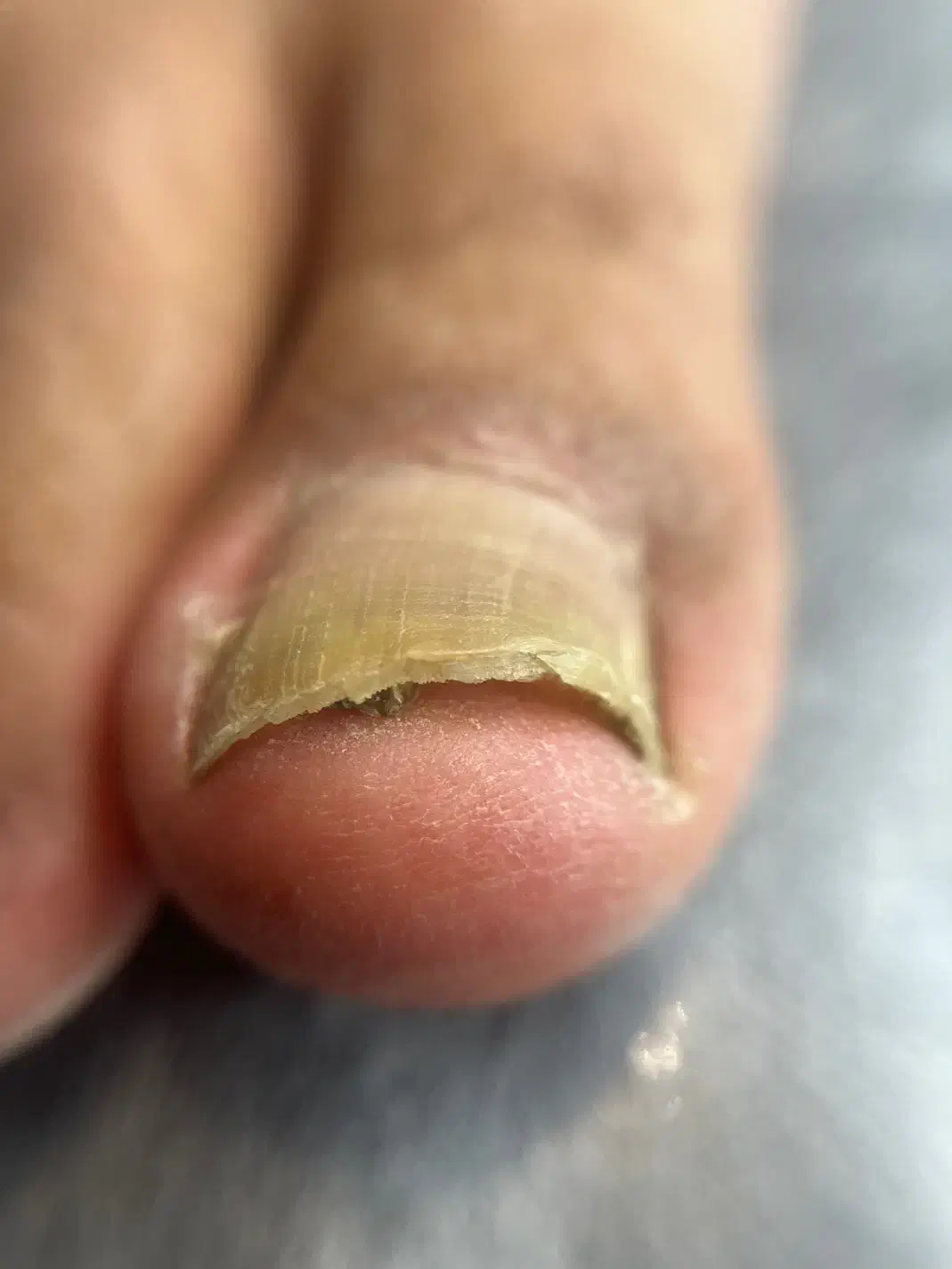 فرورفتگی ناخن توگوشت|آرایشی، بهداشتی، درمانی|انار, |دیوار