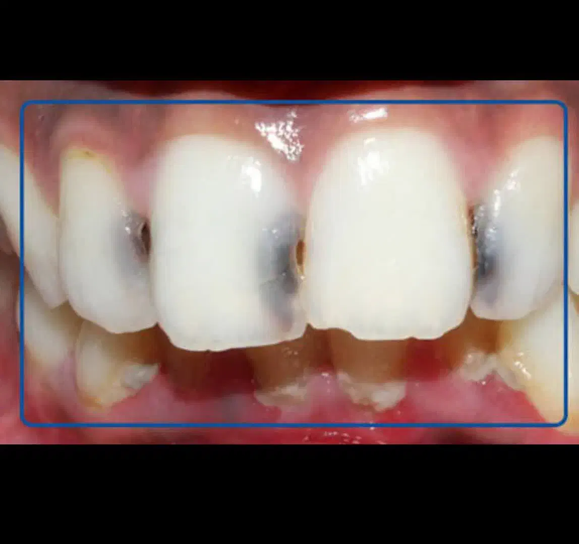 عصبکشی اندو دندان جلو۱۲۳تعرفه دولتی|خدمات آرایشگری و زیبایی|قم, زنبیل آباد|دیوار